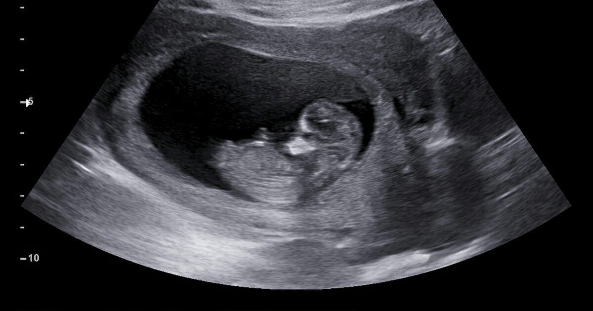 Ultraljud, graviditet