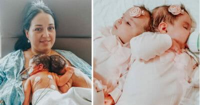 Sammanväxta tvillingar