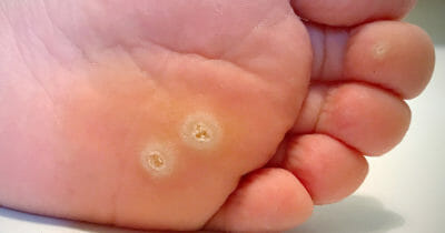 fotvårtor, behandling, huskur