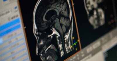 Hjärna, hjärnan, röntgen, CT, CT scan, röntgenbild